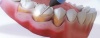 Откуда берутся зубной камень и зубной налет, как с ними бороться?